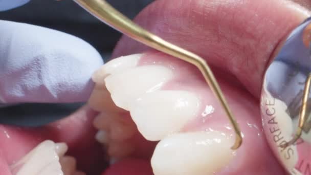 Macro Shot Dentist Working on Patients Teeth — Stockvideo