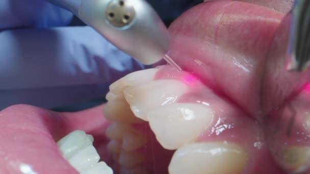 Macro Shot Dentist Working on Patients Teeth with Laser Treatment — Stockvideo