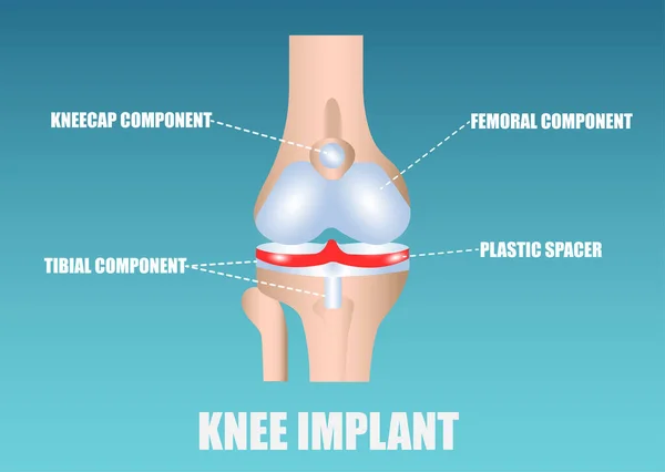 Vector Human Knee Implant — Stock Vector