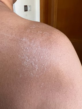 Güneş yanığı olduktan sonra Asyalı bir adamın omzundan çıkan kuru deri. Cilt bakımı kavramı.