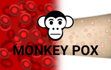 monkey pox virus pendamic background with blur infected hand and virus in blood. health care awareness illustration.