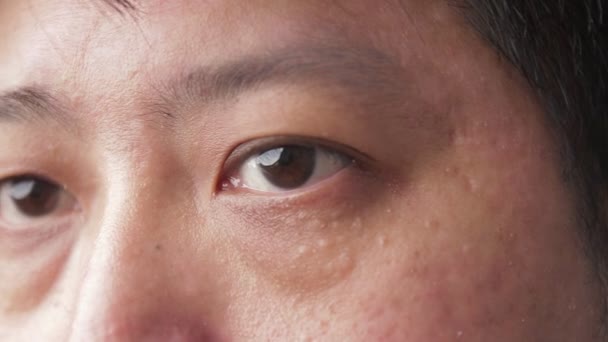 Asian Men Have Dry Eyes Concept Eye Disease Eye Health — Video