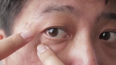 Asian men have dry eyes. concept of eye disease Eye health check. Chronic glaucoma in people aged 40 years. Skin disease, acne problems.