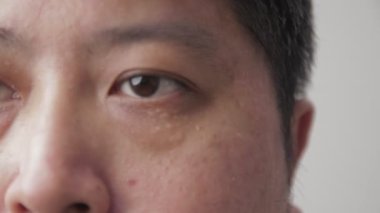 Asian men have dry eyes. concept of eye disease Eye health check. Chronic glaucoma in people aged 40 years. Skin disease, acne problems.