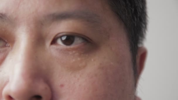 Азіатських Чоловіків Сухі Очі Концепція Перевірки Здоров Очей Хронічна Глаукома — стокове відео