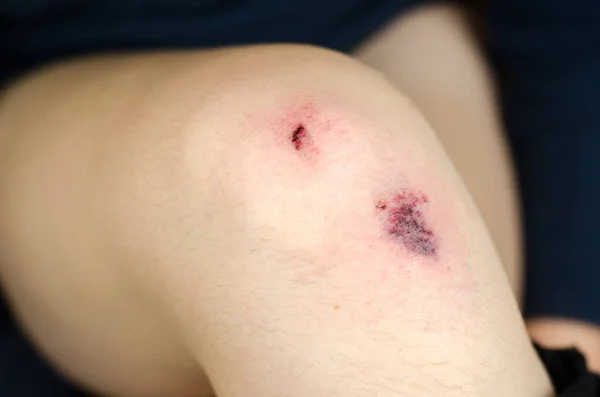 다리에 부상을 입었어요 여성의 무릎에 상처가 있습니다 — 스톡 사진