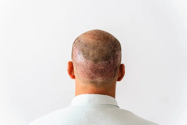 After hair transplantation surgical technique that moves hair follicles. Young bald man with hair loss problems. White background with copy space.
