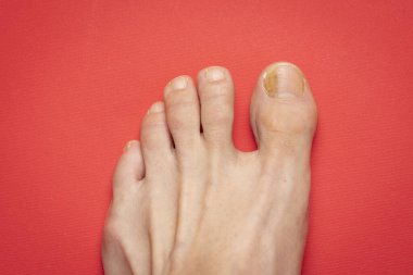 Tırnak mantarı problemleri, onikomikoz, ayrıca tinea unguium olarak da bilinir, tırnağın mantar enfeksiyonudur..