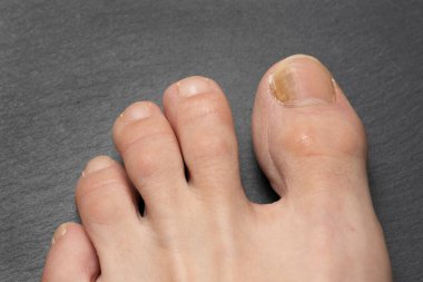 Mantar problemleri olan ayak tırnakları, onikomikozis, ayrıca tinea unguium olarak da bilinir, çivinin mantar enfeksiyonudur..