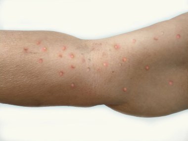 Maymun Çiçeği virüsü salgını. Kolunda kabarcıklar olan bir enfeksiyon. Tehlikeli bir hastalık..