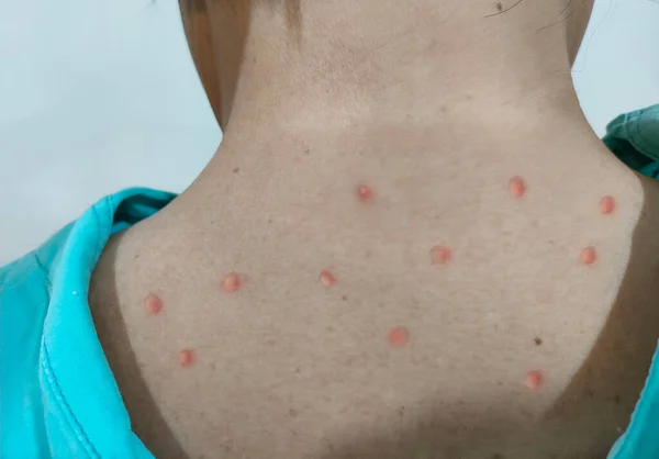 Maymun Çiçeği virüsü salgını. Cilt hastalığından su toplamış. Salgın, hastalık.