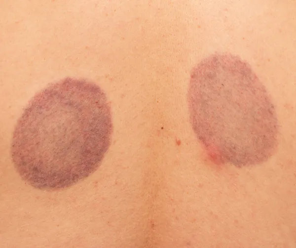 Bruises Skin Back — Stock Photo, Image