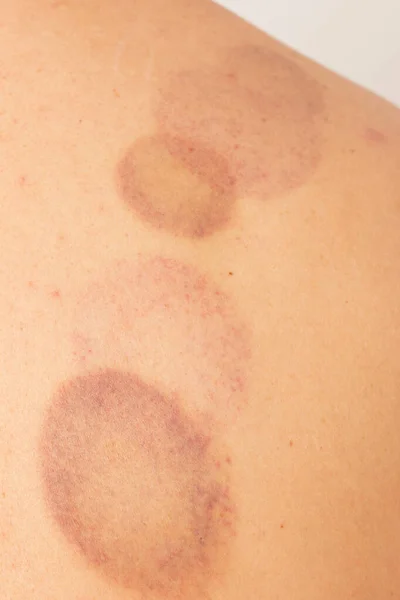 Bruises Skin — Stock Photo, Image