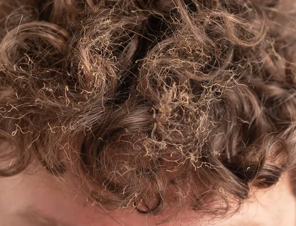 Спалене Волосся Голові — стокове фото