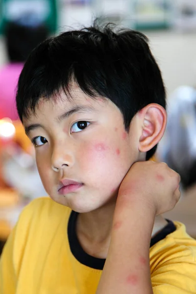 Παιδί με πολλαπλά τσιμπήματα των κουνουπιών — Φωτογραφία Αρχείου