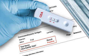 Carcinoembryonic Antigen (CEA) positive test result by using rapid testing device held by hand in medical glove with medical face mask in background. CEA is a tumor marker that detects intestinal cancer. clipart