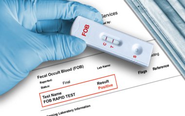 Fecal Occult Blood (FOB), arka planda tıbbi yüz maskesi olan tıbbi eldivende elle tutulan hızlı test cihazını kullanarak pozitif sonuç verdi. FOB testi kolon kanseri, ülser, polip, kolit, divertikülit gibi gastrointestinal sorunlar saptıyor.