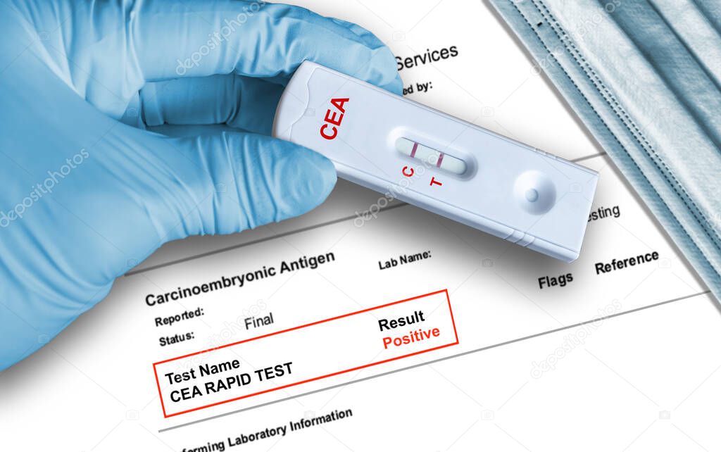 Carcinoembryonic Antigen (CEA) positive test result by using rapid testing device held by hand in medical glove with medical face mask in background. CEA is a tumor marker that detects intestinal cancer.