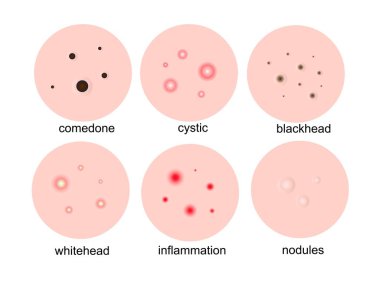 Deride sivilceler. Sivilce, sivilce, kistik, iltihap, yüzdeki beyaz başlıklar. Vektör illüstrasyonu..