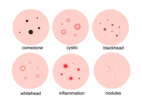 Pimples on the skin. Types of acne, acne comedones, cystic, inflammation, whiteheads on the face.Vector illustration.