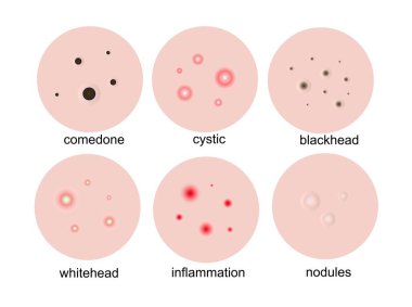 Deride sivilceler. Sivilce, sivilce, kistik, iltihap, yüzdeki beyaz başlıklar. Vektör illüstrasyonu..