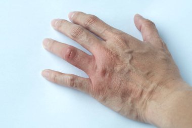 Dermatolojik deri hastalıkları konsepti: Genç bir adam acı çeken bir el, iltihaplı vücut parçaları rahatsızlık ve kaşıntıya neden olur, alerji nöbetleri geçirir..