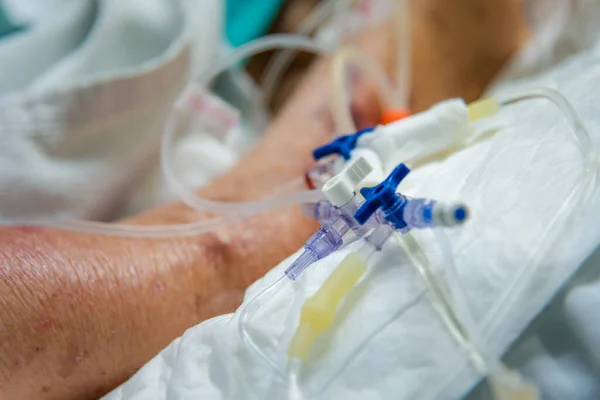 Paciente Asiática Idosas 80S Gripe Covid19 Fazem Traqueostomia Usam Ventilador — Fotografia de Stock