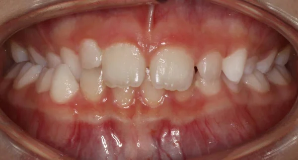 Professzionális fogászati közelkép. Egy 9 éves fiú, fehér fogak, fogorvosi vizsgálat.. Jogdíjmentes Stock Fotók