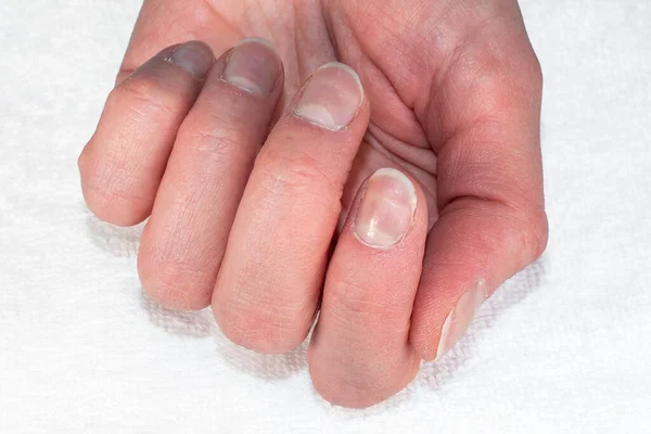 Close-up of a Caucasian female hand with natural unpolished nails, overgrown cuticles on a textile white background, top view. Nail beauty and health concept — Stock Photo, Image