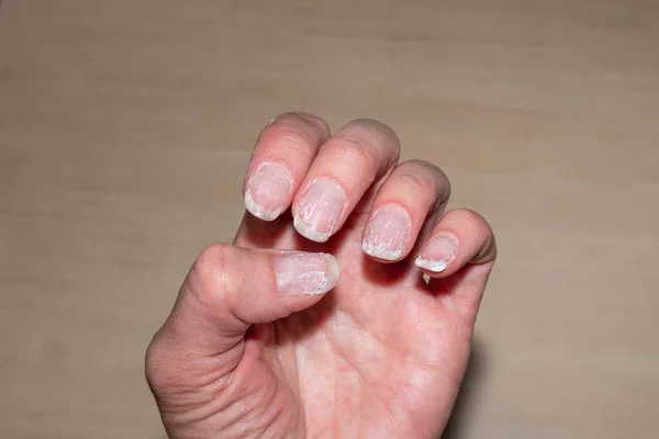 Close-up af flaky bidt og skøre negle uden manicure. Regrown søm neglebånd og beskadiget negleplade efter gel polish. Sundhed og skønhed problemer. Neglepleje og sundhed koncept. - Stock-foto