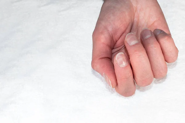 Кавказская женская рука с натуральными неполированными ногтями, заросшая кутикулами на белом фоне — стоковое фото
