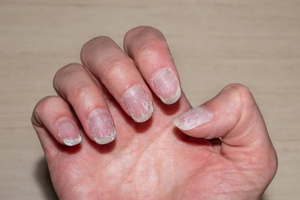 Flaky bitten and brittle nails without a manicure. Regrown nail cuticle and damaged nail plate after gel polish. — Stock Photo, Image