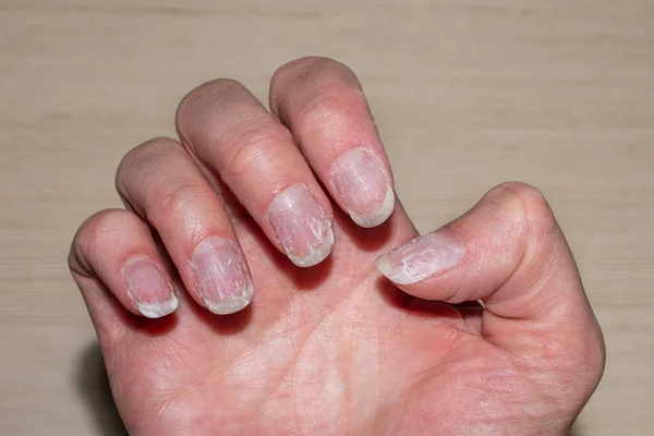 Uñas escamosas mordidas y quebradizas sin manicura. cutícula de uñas regeneradas y placa de uñas dañada después del esmalte de gel. —  Fotos de Stock