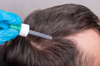 Mavi eldivenli bir doktor tedavi için saç köklerine damlatan bir pipetle damlıyor.