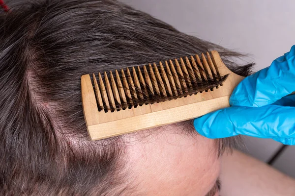 Calvície humana ou perda de cabelo um médico em luvas médicas azuis examina o cabelo e couro cabeludo de um homem — Fotografia de Stock