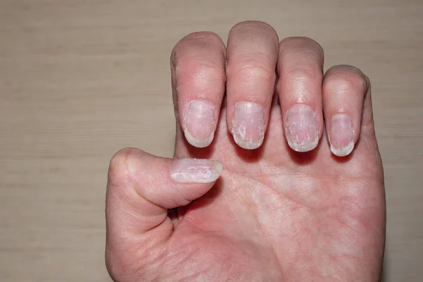 Närbild av bitna och sköra naglar utan manikyr. Makro foto av vertikala åsar i naglarna. — Stockfoto