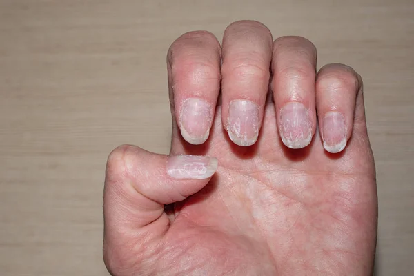 Close- up of bitten and brittle nails without manicure. Macro photo of vertical ridges in fingernails. — Stock Photo, Image