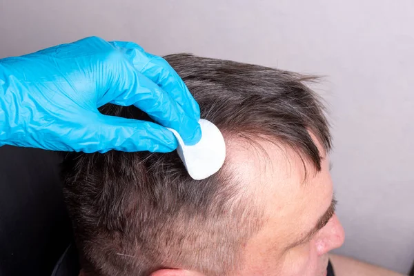 Lékař v modrých lékařských rukavicích si prohlíží vlasy a pokožku muže a otře si je vatou. Léčba vlasů a vlasové pokožky — Stock fotografie
