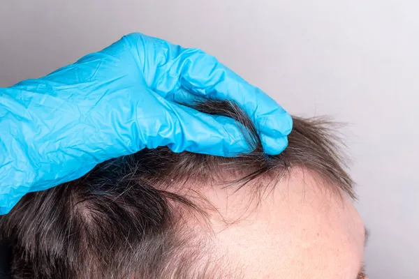 Calvície Humana Perda Cabelo Após Coronavírus Médico Luvas Médicas Azuis — Fotografia de Stock