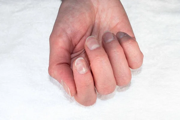 一只白种人的手的特写用天然的未经抛光的指甲 白色背景的长出的角质层 顶部视图 复制空间 天然钉子的概念 原始钉子 — 图库照片