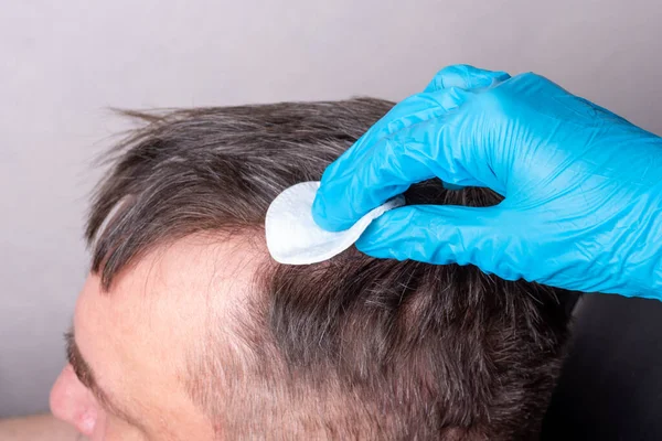 Tratamiento de la pérdida de cabello humano después del Coronavirus. Un médico con guantes médicos azules examina el cabello y el cuero cabelludo de un hombre. Imágenes de stock libres de derechos