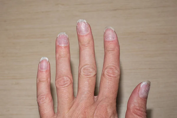 Close-up of flaky bitten and brittle nails without a manicure. Regrown nail cuticle and damaged nail plate after gel polish. Health and beauty problems. Nail care and health concept. — Stock Photo, Image