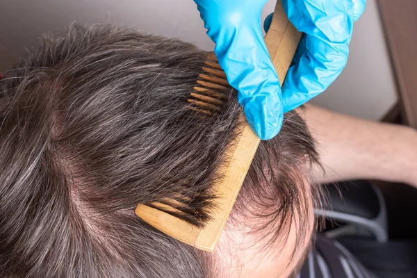 Calvície Humana Perda Cabelo Médico Luvas Médicas Azuis Examina Cabelo — Fotografia de Stock