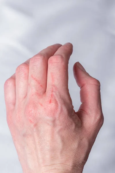 Condición de la piel después de un arañazo y mordedura. Una mano arañada por un gatito curioso, un gato. Heridas rojas en el brazo, primer plano — Foto de Stock