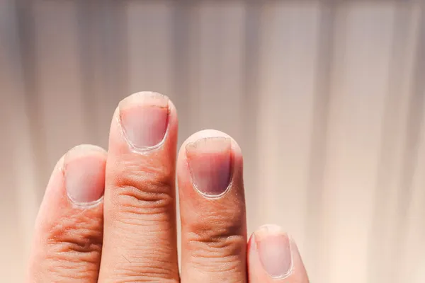 Грязные Ногти Показать Грязные Ногти Которые Требуют Срочного Лечения Грязные — стоковое фото