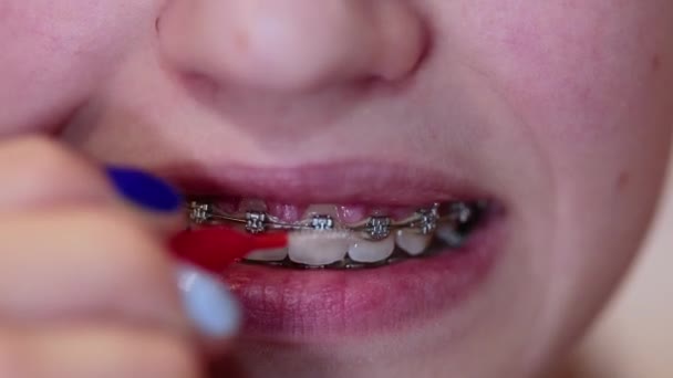 Unrecognizable caucasian female clean teeth with braces — Αρχείο Βίντεο