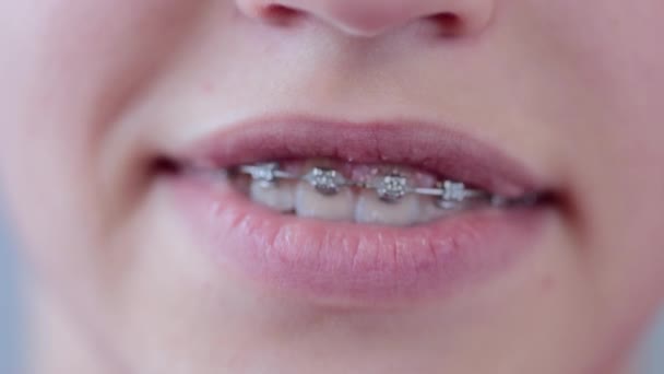 Close up of a girl smiling with braces on teeth. Orthodontic Treatment. — Video Stock
