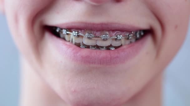 Close up of a girl smiling with braces on teeth. Orthodontic Treatment. — Stock Video