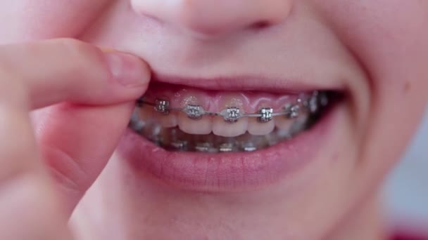 Girl applies rubber bands on teeth with braces for perfect smile — Video Stock