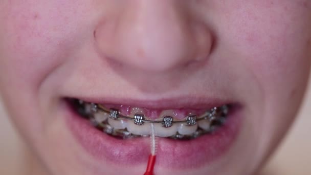 Unrecognizable caucasian female clean teeth with braces — Stockvideo